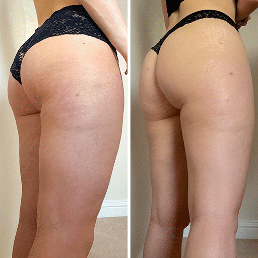 Oslo Skin Lab kollageenin ennen ja jälkeen kuvia